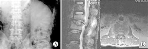 (A) Preoperative radiographs reveal pyogenic spondylitis in L2-3. (B ...