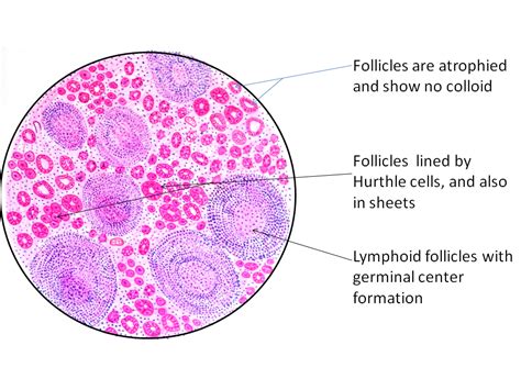 Hashimotos Thyroiditis - Pathology Made Simple