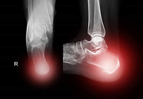 Heel Spur X Ray Stock Photos, Pictures & Royalty-Free Images - iStock