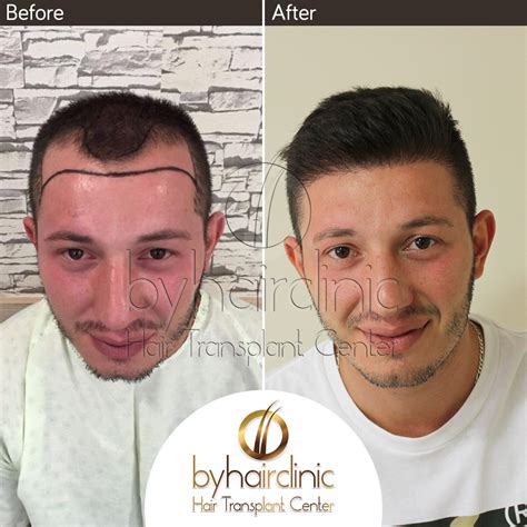 Fue Hair Transplantation Turkey – bysacekimi hair transplantation in istanbul Turkey