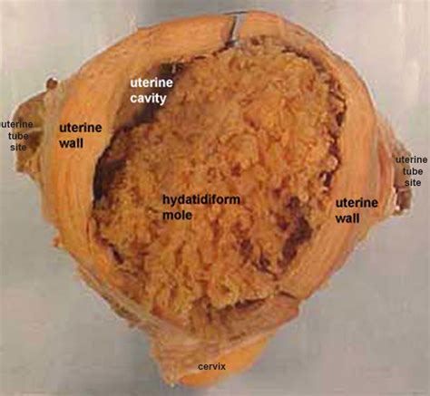 File:Hydatidiform mole.jpg - Embryology