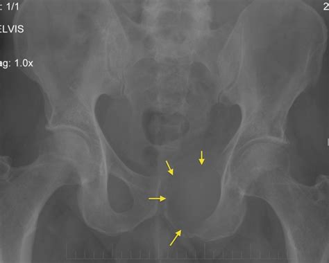 Lytic bone metastasis - Radiology at St. Vincent's University Hospital