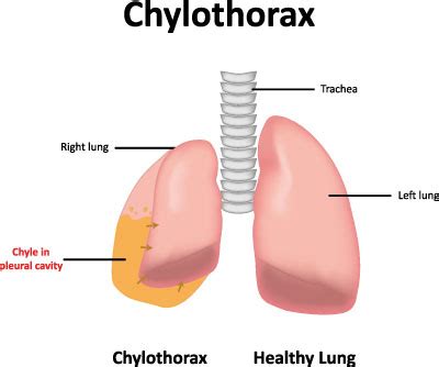 Chylothorax - Ursachen, Symptome & Behandlung | MedLexi.de