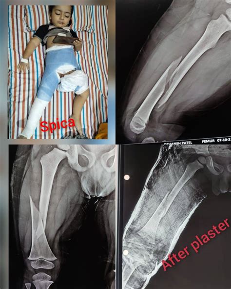 Hip Spica Cast Femur Fracture – NBKomputer