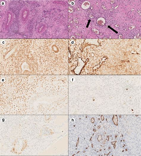 Histological and immunohistochemical features of case 3. HE images... | Download Scientific Diagram