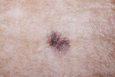 Mole Skin Cancer Symptoms Itchy - Steve