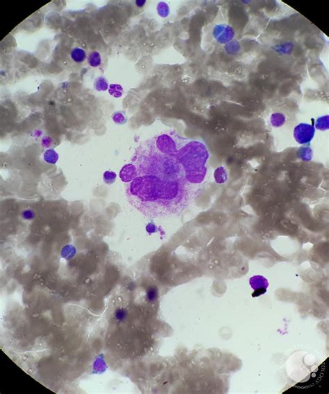 ITP megakaryocyte morphology 6