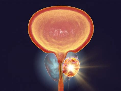 Trial to Test Focal Laser Ablation Therapy for Localized Prostate Cancer – MDSource