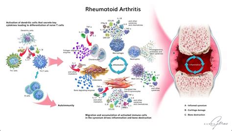 Rheumatoid Arthritis Infographic - Geras Healthcare Productions