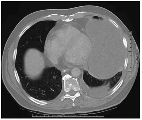 Pericardial Cyst | Thoracic Key