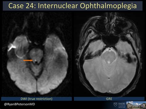 Internuclear Ophthalmoplegia Mri