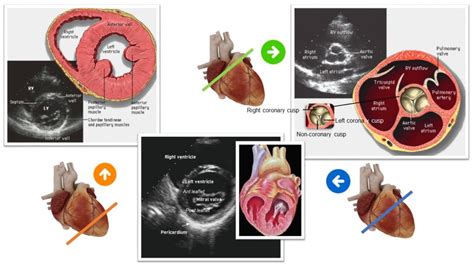 Focused Cardiac Ultrasound for the Nephrologist: The Parasternal Short Axis View - Renal Fellow ...