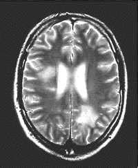 Lesion (MS lesion) | MS Trust