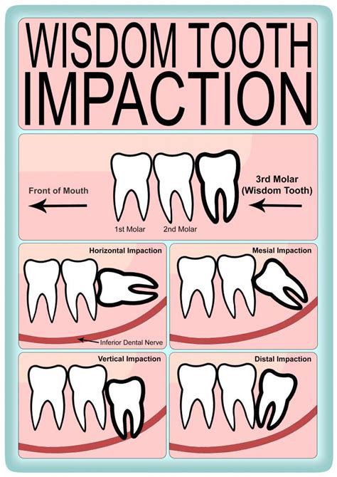 What are the different kinds of wisdom tooth impaction? | Greenlife Dental