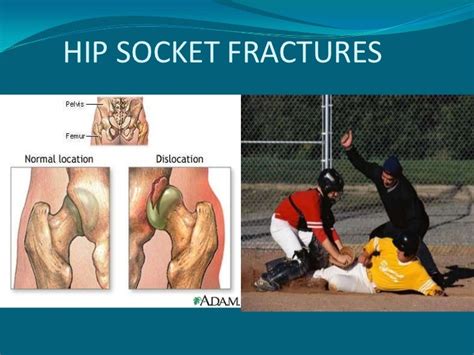 Hip Injuries In The Athelete+Arthroscopy Of The Hip