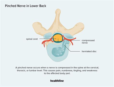 Pinched nerve in lower back causes symptoms and treatments – Artofit