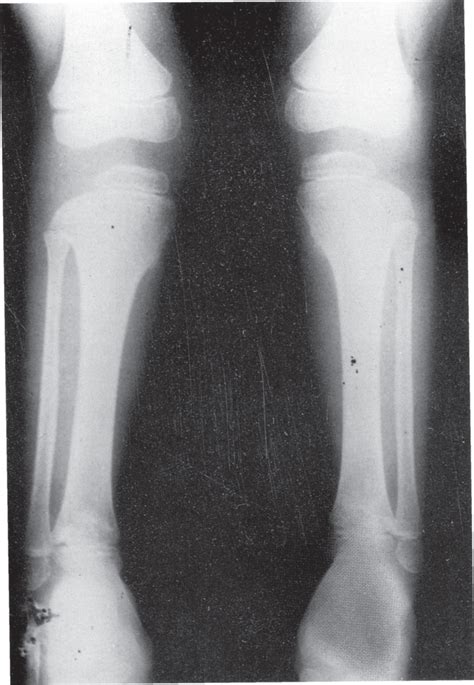 Clinical and Radiological Features of Chondroectodermal Dysplasia | Annals of Saudi Medicine