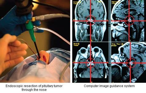 Pin on adrenal glands