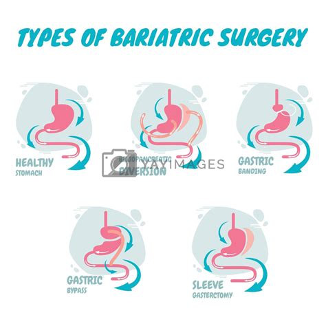 Types of bariatric surgery, it is process for the digestive system in ...