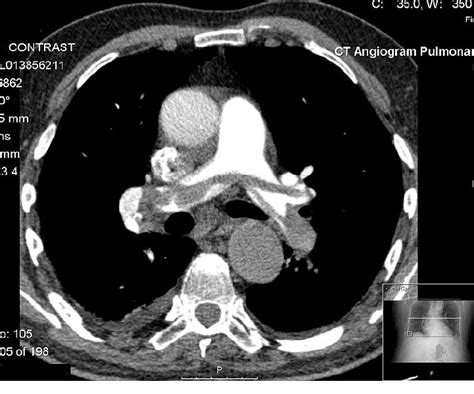 Computed tomography - wikidoc