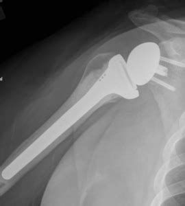 Glenohumeral Arthritis – Orthopaedia: Sports Medicine