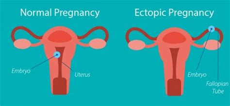 Kehamilan Ektopik: Penyebab – Gejala dan Cara Mengobati - IDN Medis