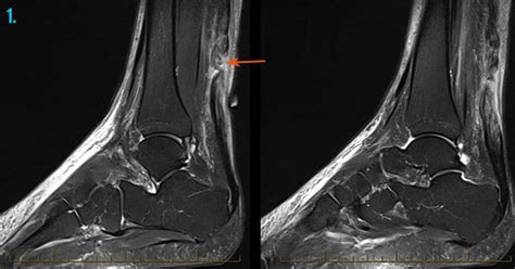 Achilles Tendon Ultrasound | Melbourne Radiology