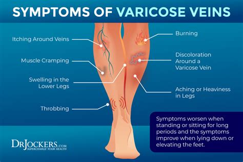 Symptoms Of Varicose Vein Disease