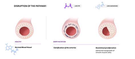 ENPP1 Deficiency | Inozyme Pharma