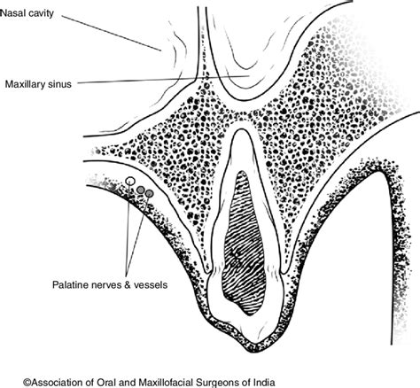 6 Surgical anatomy of maxillary canine area. Note the close ...