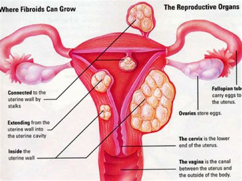 Ramai Wanita Tak Tahu Ada Cyst & Fibroid, Adakah Anda Berisiko? - Pesona Pengantin