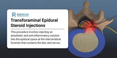 Transforaminal Epidural Steroid Injections NJ | Corticosteroids Injections