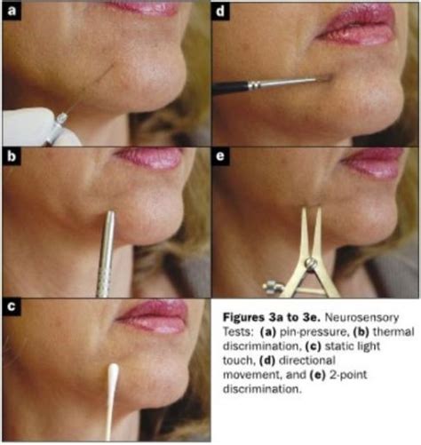 Dental Implant Nerve Damage - Classify and treatment - Wheaton Dentist ...