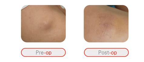 Epidermal Cyst Removal in Hong Kong: Cost & Procedure