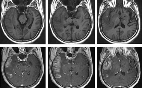 MCA infarction or HSV encephalitis? – Radiology Cases