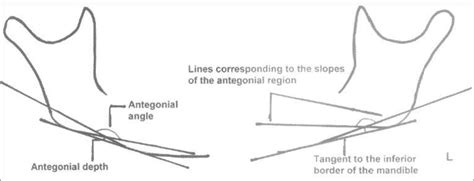 Method of measuring Antegonial angle and depth. | Download Scientific Diagram