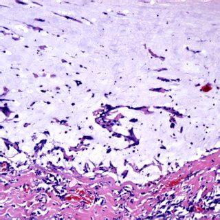 (continued) – LAMN histology, HE staining: (c) Lakes of mucin and ...