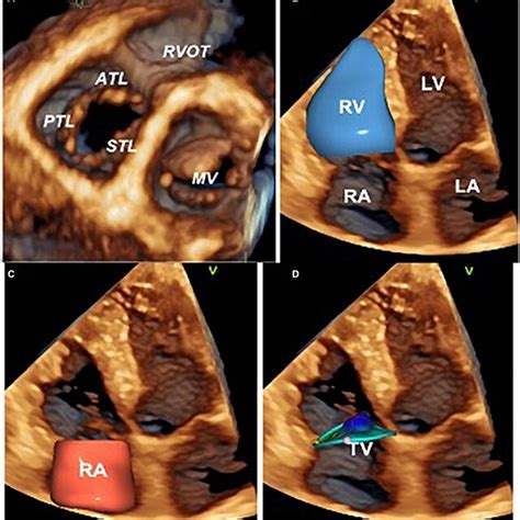 Three-dimensional echocardiography assessment of the tricuspid valve,... | Download Scientific ...