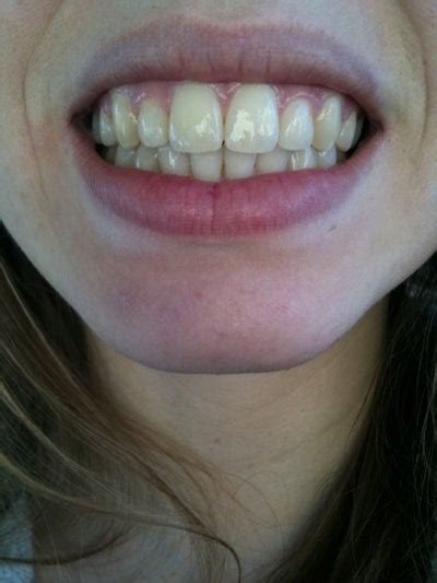 How Can I Fix my Big Front Teeth? Dentist Answers, Tips