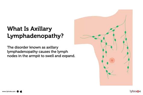 Axillary lymphadenopathy: Causes, Symptoms, Treatment and Cost