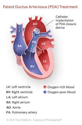 Patent Ductus Arteriosus (PDA) | Children's Hospital of Philadelphia