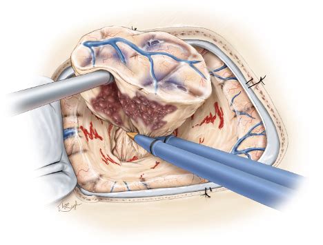 Cavernous Malformation Surgery | Aaron Cohen-Gadol, MD