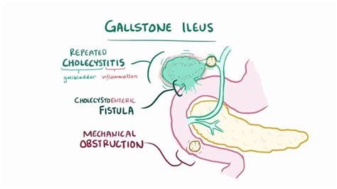 Gallstone ileus: Video, Anatomy, Definition & Function | Osmosis