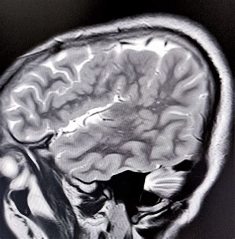 Polymicrogyria : MRI Teaching Case - Sumer's Radiology Blog