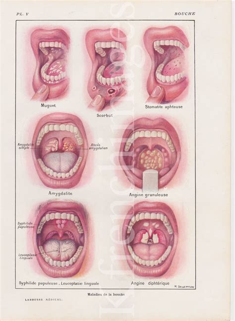 Mouth Diseases Anatomy Plate French Vintage Original Print 1920's ...