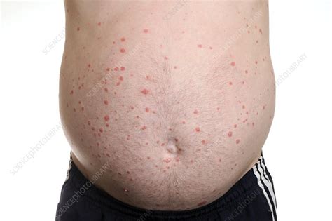 Guttate psoriasis - Stock Image - C023/8925 - Science Photo Library