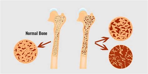 homeopathic treatment for Brittle bone disease in homeopathy, Brittle bone disease Treatment in ...