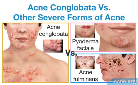 What Is Acne Conglobata? - Acne.org