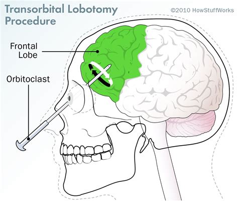 Soul Surgery: Successes and Failures in Lobotomy Patients - Lobotomy ...