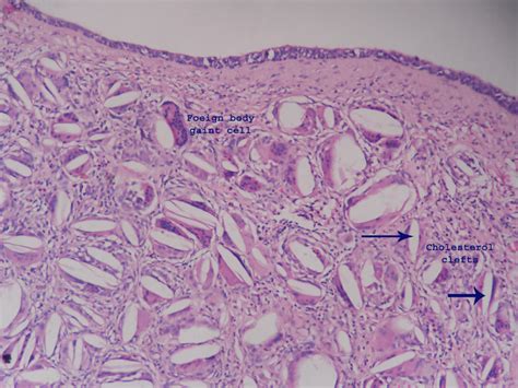 Branchial cleft cyst – Histopathology.guru